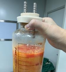 姜堰水动力吸脂手术要做多久？